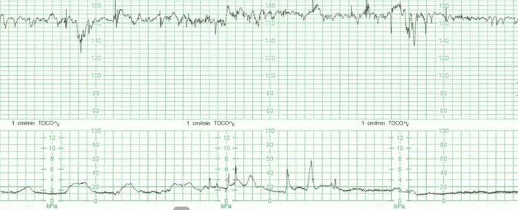 Fetale Hypoxie und Azidose – CTG: Fetale Tachykardie mit einer Baseline um 170 bpm