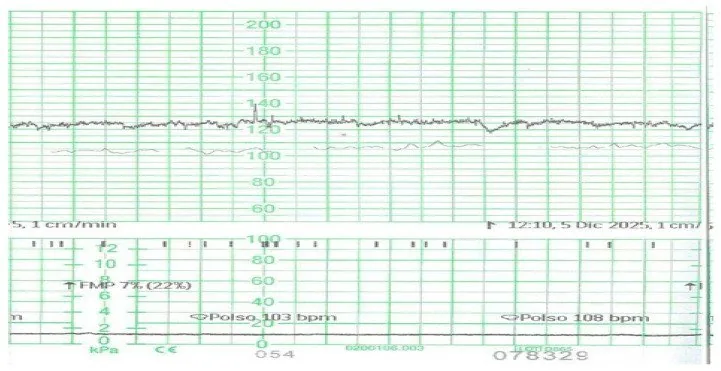 Fetale Hypoxie und Azidose – CTG: Silentes Muster: die Bandbreite der Oszillation liegt unter 5 bpm