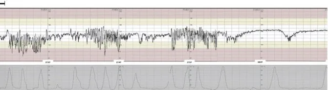 Fetale Hypoxie und Azidose – CTG: Saltatorisches Muster: Episoden mit einer Bandbreite über 25 bpm zwischen normalen Abschnitten