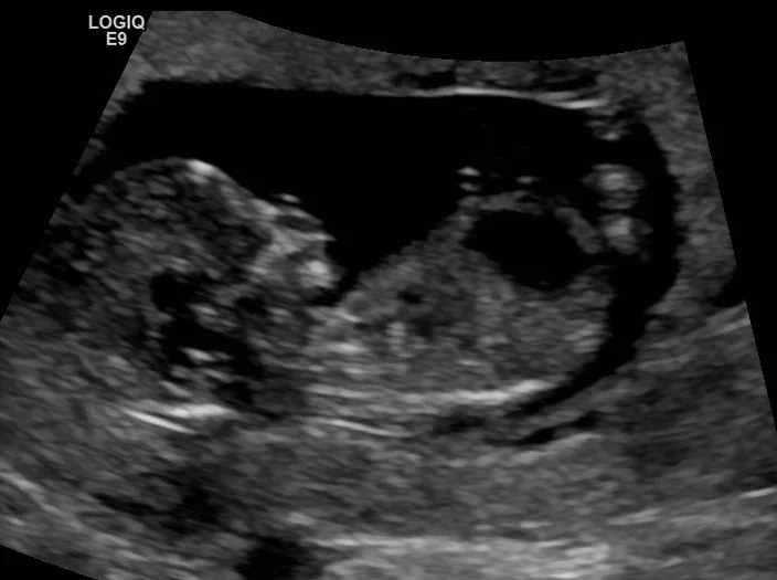 Fetal renal anomalies – Ultrasound