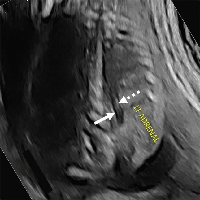 Fetal renal anomalies – Clinical