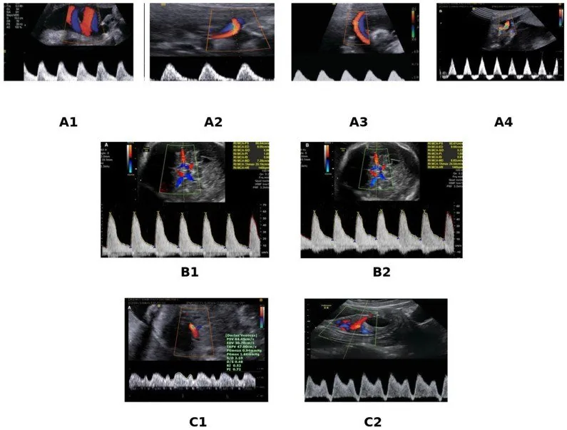 Fetal growth restriction (FGR) – Ultrasound: Progressive Doppler changes in growth restriction: umbilical artery through to reversed flow, MCA brain sparing, ductus venosus with a reversed a-wave (Photo: Caetano ACR, Zamarian ACP, …