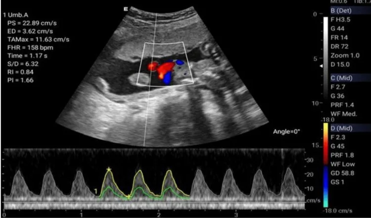 Fetal growth restriction (FGR) – Clinical: Velamentous cord insertion: the umbilical vessels run unprotected across the membranes (Photo: Mpourazanis G, Flindris S, Pantazis K, Alefragkis D, Papalexis P, Korkontzelos I, Kosmas I …