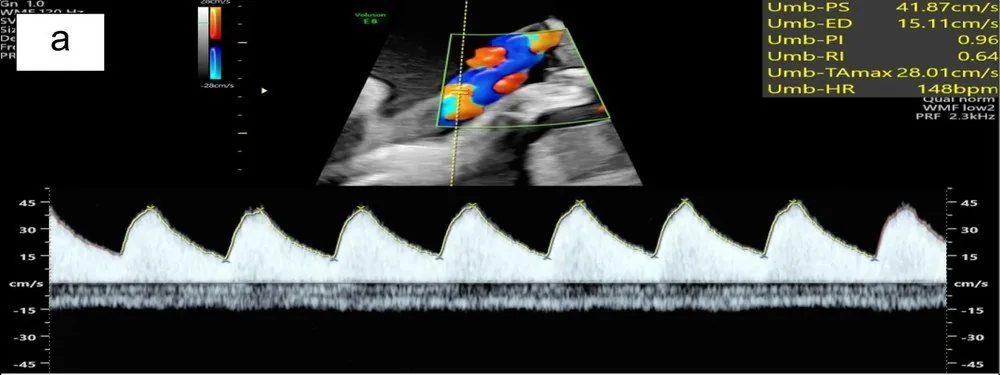 Fetal growth restriction (FGR) – Ultrasound: A normal umbilical artery waveform at 29+2 weeks with brisk forward end-diastolic flow (Photo: Ackah JA, Mensah WS, Chen X, Dyer E, Chukwanugo UC, Ven Emery C, Akudjedu TN. (Archives of …