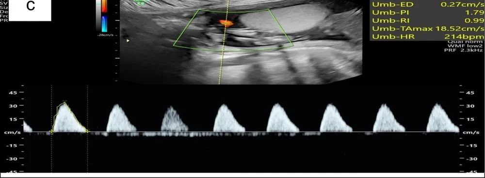 Fetal growth restriction (FGR) – Clinical