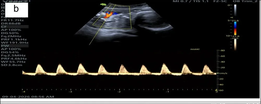 Fetal growth restriction (FGR) – Ultrasound: Umbilical artery with absent end-diastolic flow — the trace drops to the baseline between beats (Photo: Ackah JA, Mensah WS, Chen X, Dyer E, Chukwanugo UC, Ven Emery C, Akudjedu TN. …