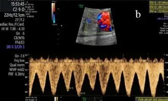 Fetal growth restriction (FGR) – Ultrasound: Middle cerebral artery side by side: a normal pulsatility index (A) versus brain sparing with increased diastolic flow (B) (Photo: Sá MI, Illa M, Guedes-Martins L. (Diagnostics (Basel, …
