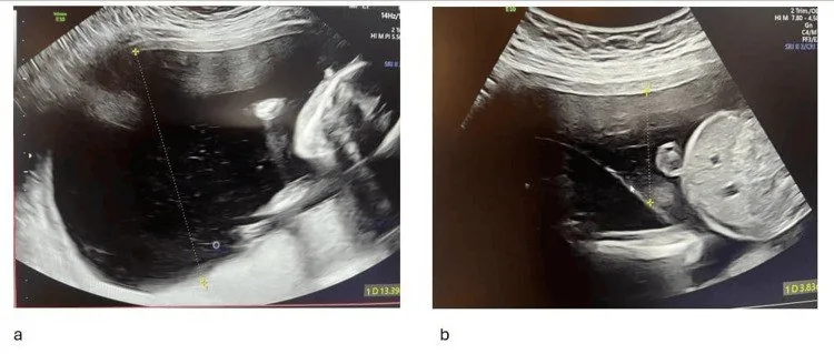 Fetofetales Transfusionssyndrom (FFTS) – Sonographie: Fetofetales Transfusionssyndrom: Polyhydramnion beim Akzeptor, wenig Fruchtwasser beim Donor (Foto: Zijaj L, Prifti E, Rexha Shahini A, Kashami A, Kohlberger P. (Cureus, 2026), Open …