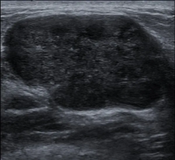 Fibroadenom – Sonographie: Mammasonographie: echoarme Einschmelzung mit unregelmäßiger Wand — Mammaabszess