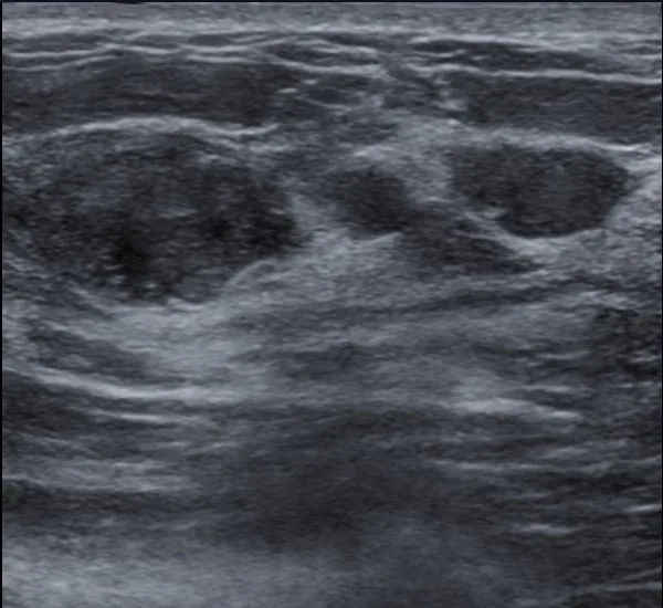 Fibroadenom – Sonographie: Mammasonographie: erweiterter Milchgang mit solider intraluminaler Raumforderung — intraduktales Papillom