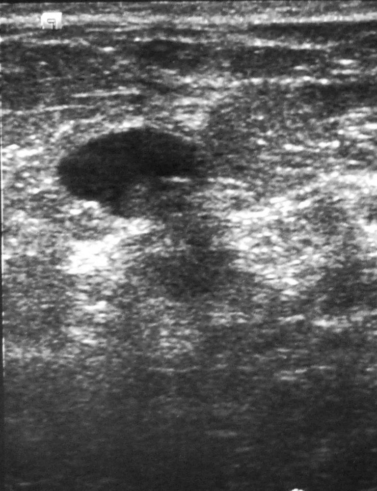 Fibroadenom – Klinik: Fibroadenom — ovaler, glatt berandeter, homogen echoarmer Herd, breiter als hoch