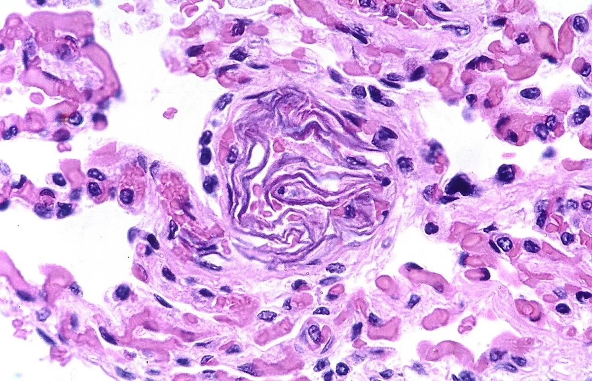 Amniotic fluid embolism – Histology & cytology: Histology (H&E): fetal squamous cells within a maternal pulmonary arteriole – amniotic fluid embolus