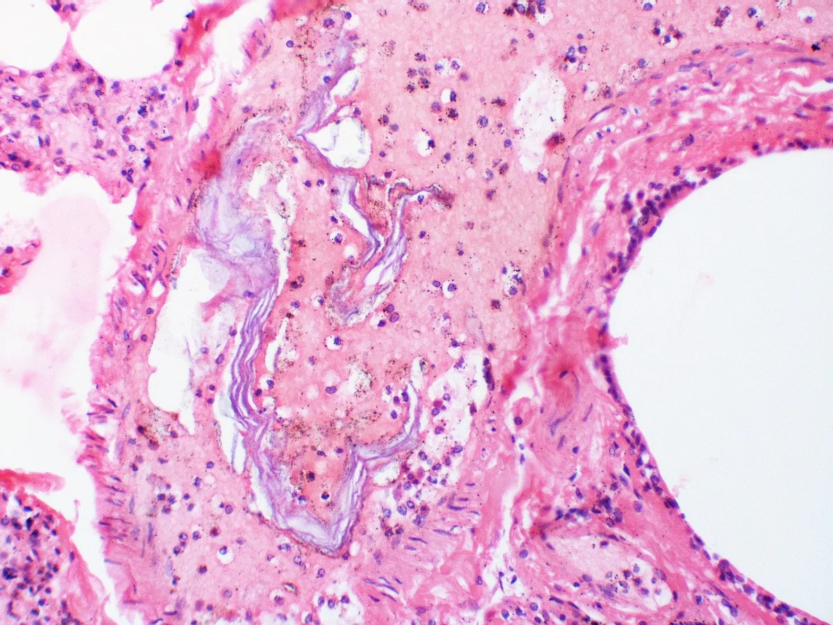 Amniotic fluid embolism – Histology & cytology: Histology (H&E): intravascular fetal squames in a pulmonary vessel – amniotic fluid embolus