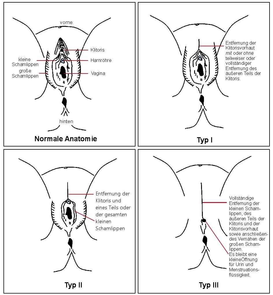 Weibliche Genitalverstümmelung (FGM) – Schema: Schema: WHO-Typen I–III der weiblichen Genitalverstümmelung neben der normalen Anatomie – Typ I Entfernung von Klitorisvorhaut/Klitoris, Typ II zusätzlich der kleinen Labien, Typ III …