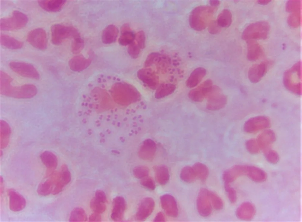 Gonorrhoea – Clinical