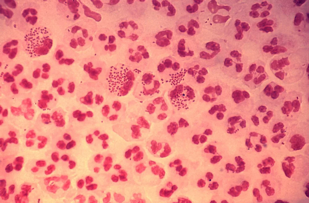 Gonorrhoea – Endoscopy & gross