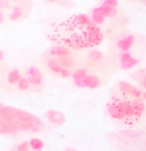 Gonorrhoea – Clinical