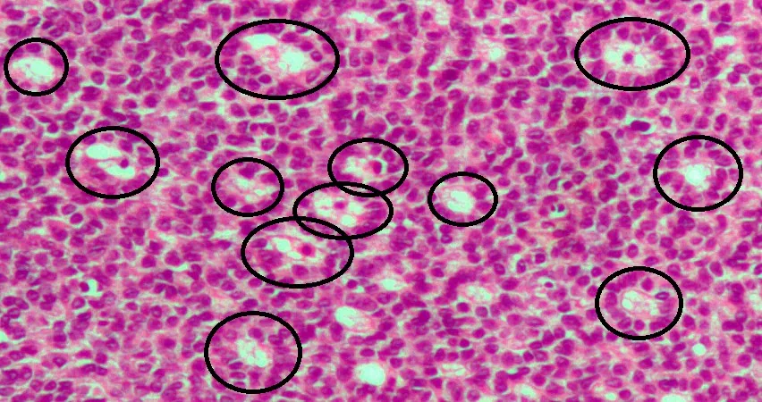 Granulosa cell tumour and sex cord-stromal tumours – Histology & cytology: Histology (H&E): adult granulosa cell tumour – diffuse sheets of small cells with Call-Exner bodies (rosette-like spaces, circled in black)