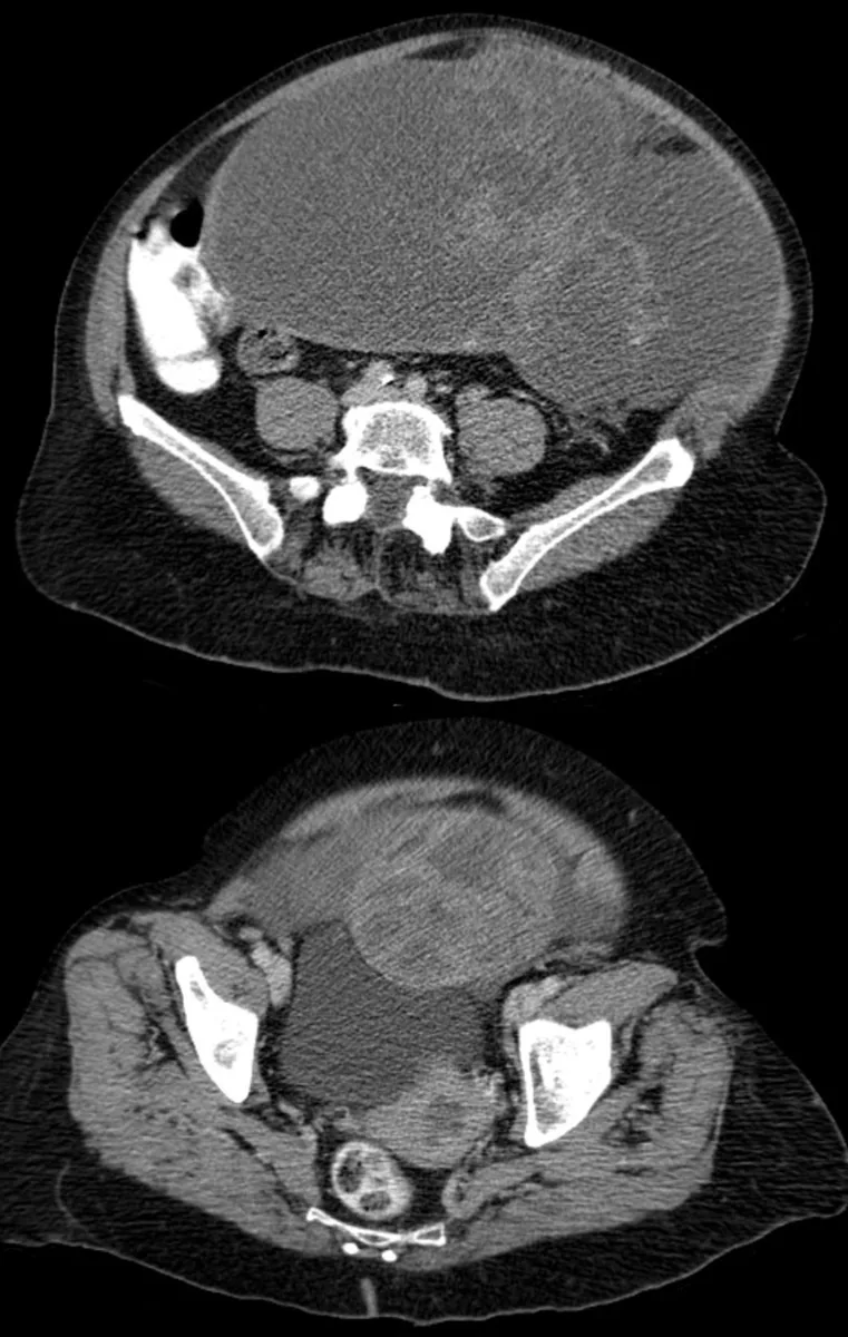 Granulosa cell tumour and sex cord-stromal tumours – Mammography/MRI: CT (axial, contrast-enhanced): adult granulosa cell tumour of the ovary in a 78-year-old woman – very large, cystic, multiseptate tumour with solid components