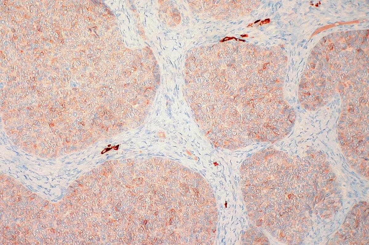 Granulosa cell tumour and sex cord-stromal tumours – Histology & cytology: Inhibin immunohistochemistry: cytoplasmic positivity of the tumour cell nests of a granulosa cell tumour, stroma negative