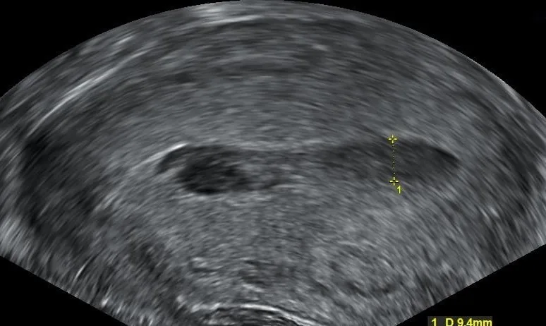 Haematometra and pyometra – Ultrasound