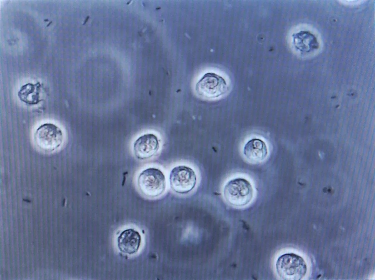 Urinary tract infections in pregnancy – Histology & cytology: Microscopy (urine sediment, phase contrast): pyuria and bacteriuria with rod-shaped bacteria in urinary tract infection