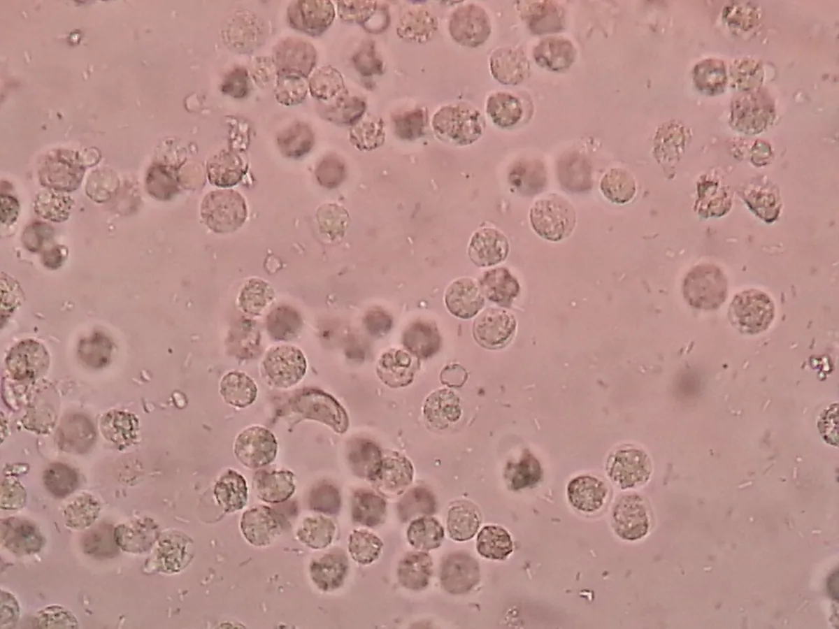 Urinary tract infections in pregnancy – Histology & cytology: Microscopy (urine sediment): numerous leukocytes (pus cells) and bacteria in bacterial urinary tract infection