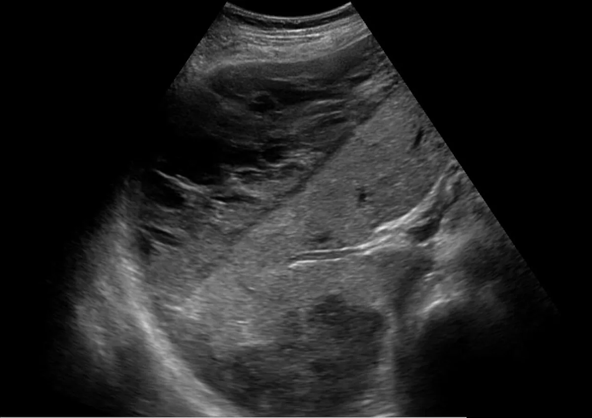 HELLP-Syndrom – Sonographie: Sonographie: großes subkapsuläres Leberhämatom bei einer Frau mit HELLP-Syndrom