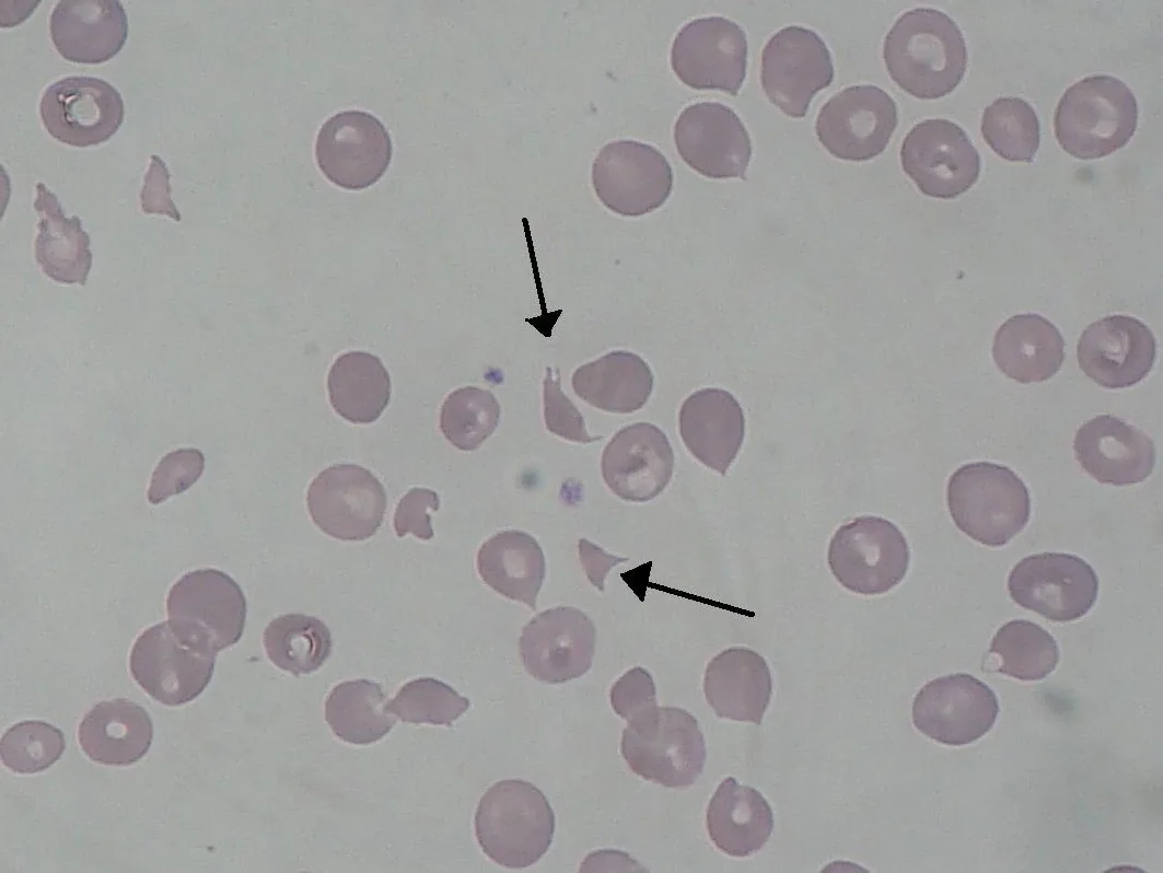 HELLP-Syndrom – Histologie & Zytologie: Mikroskopie (Blutausstrich): Fragmentozyten (Schistozyten, Pfeile) bei mikroangiopathischer Hämolyse