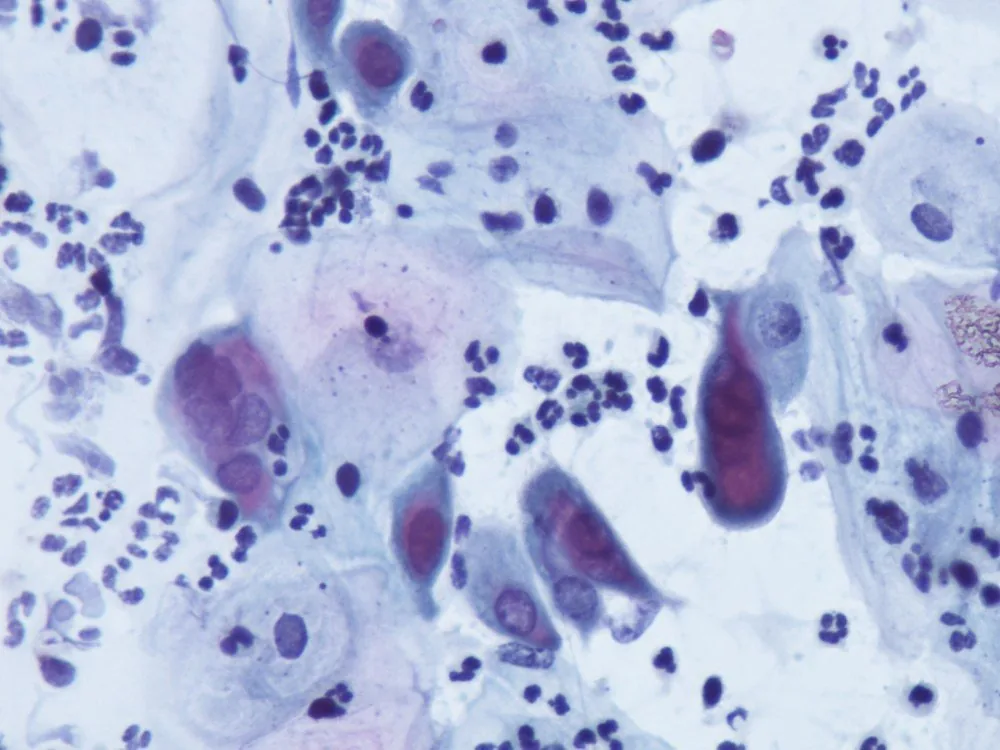 Herpes genitalis – Endoskopie & Makro: Zytologisches Präparat bei Herpesinfektion: mehrkernige Riesenzellen mit mattglasigen Kernen