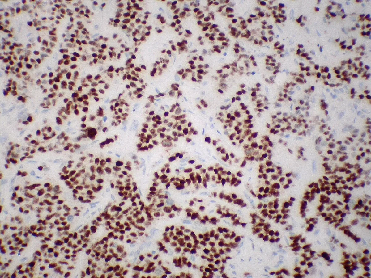 Hormone receptor-positive breast cancer (luminal A and B) – Histology & cytology: Estrogen receptor immunohistochemistry: strong nuclear staining of nearly all tumour cells of a metastatic breast carcinoma (pleura) – hormone receptor positive