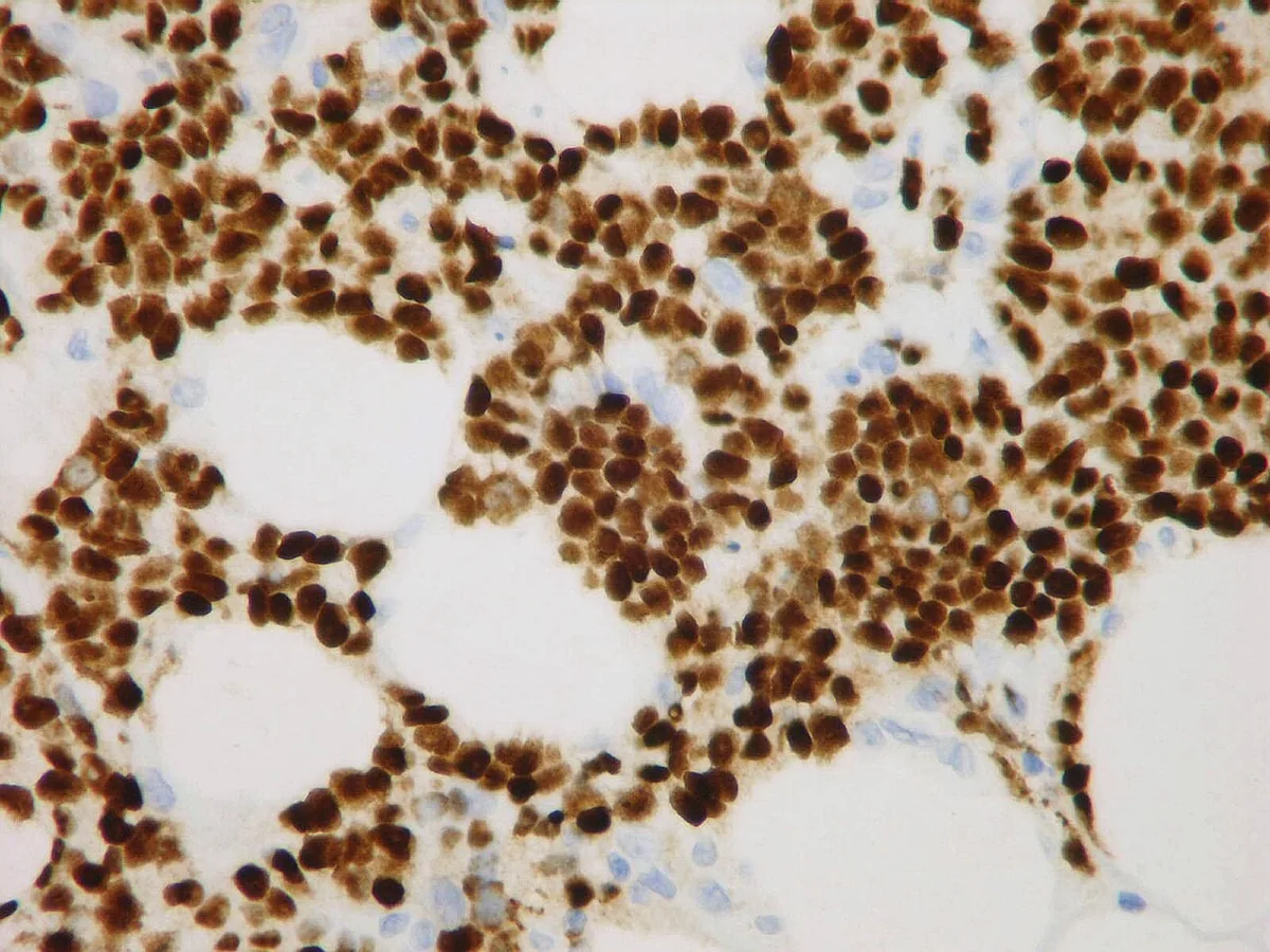 Hormone receptor-positive breast cancer (luminal A and B) – Histology & cytology: Progesterone receptor immunohistochemistry: diffuse strong nuclear staining of the tumour cells of the same metastatic breast carcinoma (pleura)