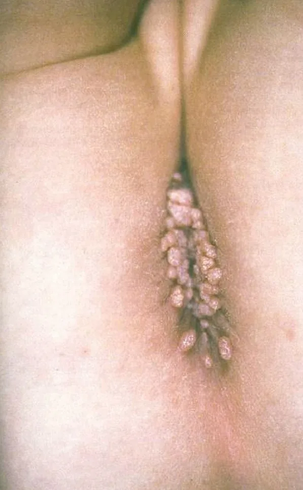HPV infection – Clinical