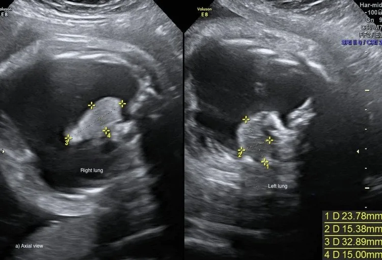 Hydrops fetalis – Ultrasound: Bilateral septated cystic hygroma at 12+3 weeks — karyotyping showed trisomy 21 (Photo: Podobnik P, Meštrović T, Podobnik M, Lončar I, Bertović-Žunec I, Kurdija K, Jelčić D, …