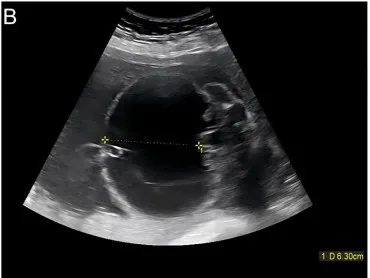 Hydrops fetalis – Ultrasound: Massively increased nuchal translucency of 14 mm with a cystic hygroma at first-trimester screening (Photo: Subbaraj C, Guma M. (Cureus, 2025), open access, CC BY 4.0)