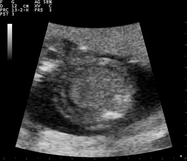 Hydrops fetalis – Clinical