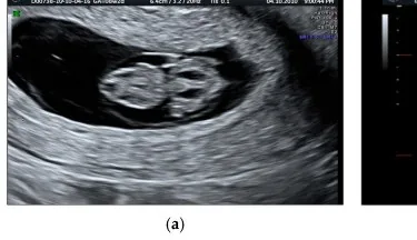 Hydrops fetalis – Ultrasound: Middle cerebral artery Doppler with a peak systolic velocity of 1.91 MoM — pointing to fetal anaemia (Photo: Yanase Y, Sirilert S, Jatavan P, Pomrop M, Phirom K, Tongsong T. (Journal of …