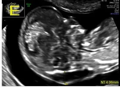 Hygroma colli und erhöhte Nackentransparenz – Sonographie: Erhöhte Nackentransparenz von 4,06 mm, oberhalb der 99. Perzentile (Foto: Korniluk M, Korniluk A, Szewczyk G. (Journal of clinical medicine, 2026), Open Access, CC BY 4.0)