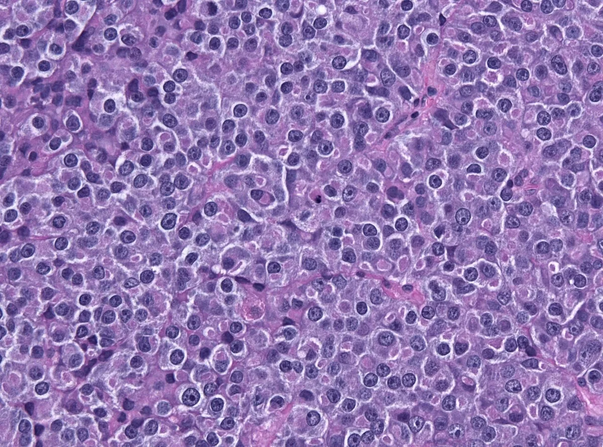 Hyperprolaktinämie und Prolaktinom – Histologie & Zytologie: Histologie (HE): Prolaktinom – solides Hypophysenadenom aus monomorphen chromophoben Zellen mit runden Kernen