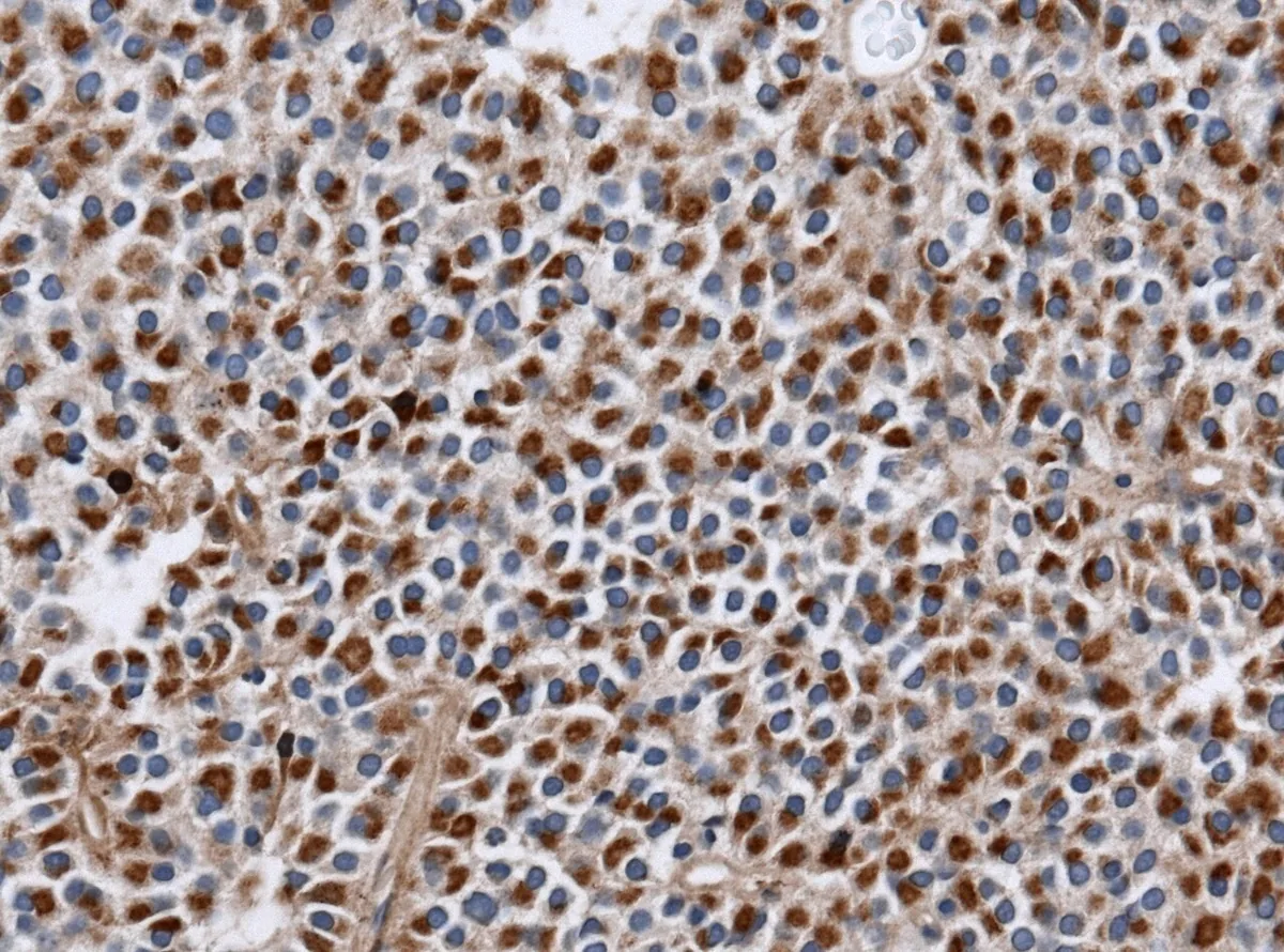 Hyperprolaktinämie und Prolaktinom – Histologie & Zytologie: Immunhistochemie Prolaktin: diffuse Prolaktin-Expression im Zytoplasma der Adenomzellen (perinukleär betont)