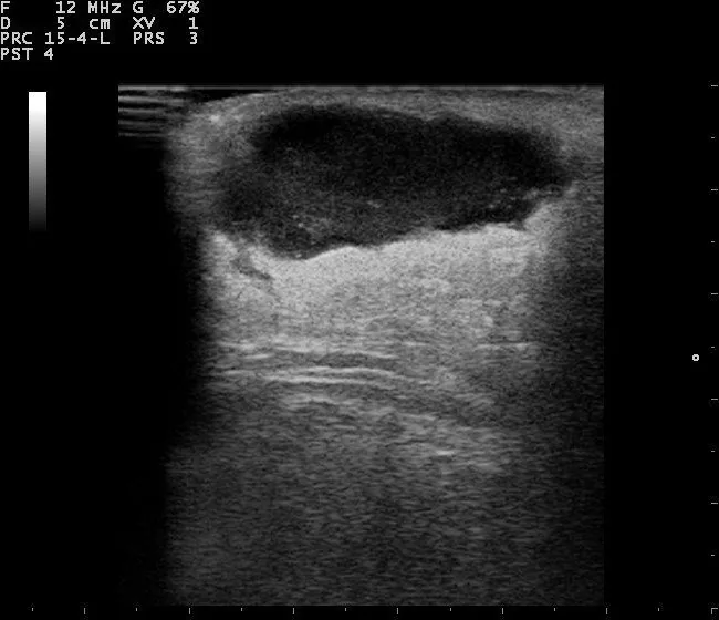Inflammatory breast cancer – Ultrasound: Breast ultrasound: hypoechoic collection with an irregular wall — breast abscess