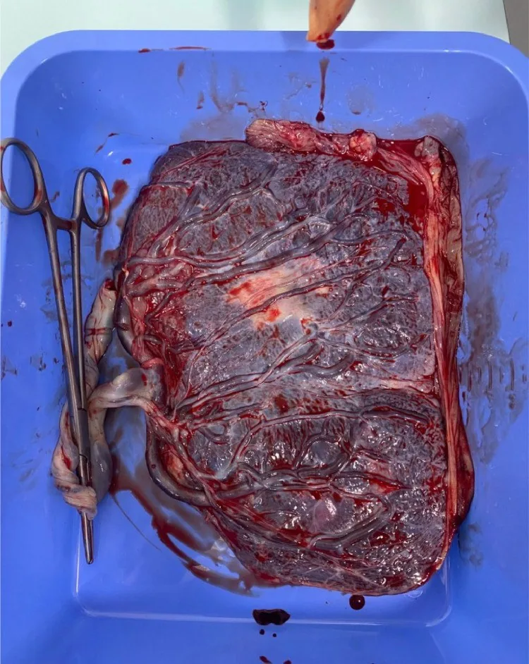 Insertio velamentosa und Nabelschnuranomalien – Endoskopie & Makro: fetale Fläche einer Placenta bipartita mit velamentöser Nabelschnurinsertion