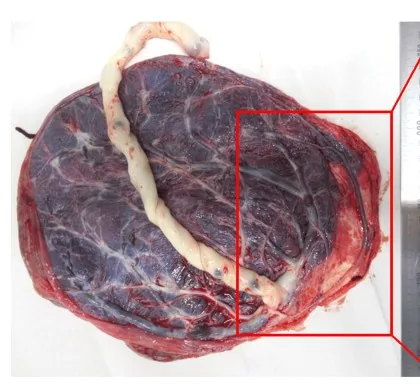 Insertio velamentosa und Nabelschnuranomalien – Endoskopie & Makro: Plazenta makroskopisch mit randständiger Nabelschnurinsertion und ungeschütztem Eihautgefäß
