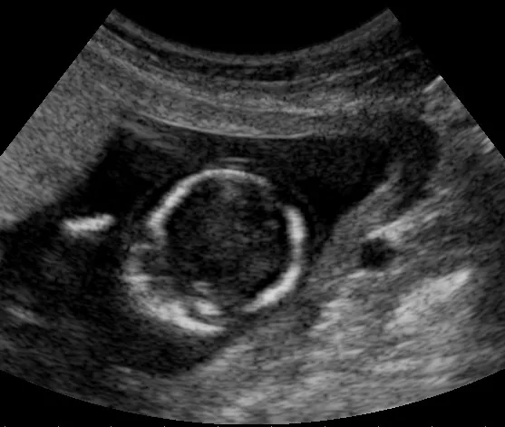 Intrauteriner Fruchttod – Sonographie: Sonographie: fetaler Schädel nach intrauterinem Fruchttod – unregelmäßige Kalottenkontur mit sich überlappenden Knochenrändern (vereinbar mit Spalding-Zeichen), aufgehobene …