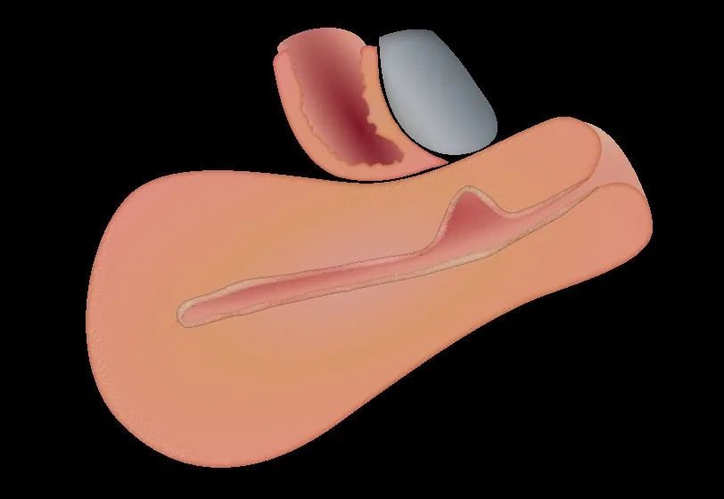 Wundheilungsstörung und Isthmozele nach Sectio – Schema: Schema: Nische (Isthmozele) – keilförmiger Defekt im Myometrium der Uterusvorderwand im Bereich der alten Sectionarbe, Sagittalschnitt