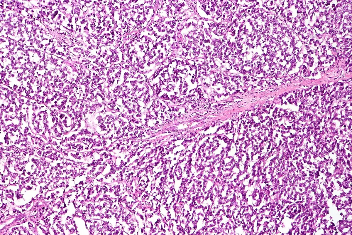Ovarian germ cell tumours – Histology & cytology: Histology (H&E): dysgerminoma – large, monomorphic tumour cells with clear cytoplasm in nests, separated by fibrous septa containing lymphocytes