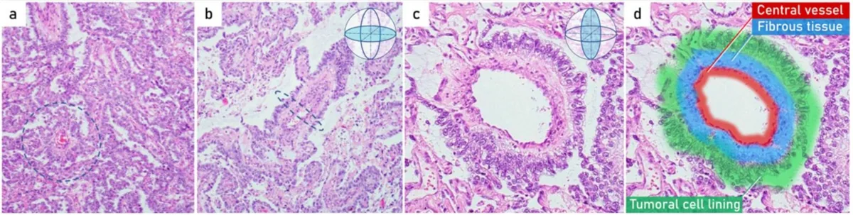 Ovarian germ cell tumours – Histology & cytology: Histology (H&E): yolk sac tumour (endodermal sinus tumour, here extragonadal in the omentum) – papillary pattern with Schiller-Duval bodies (circled in a/b; d coloured: central vessel, …