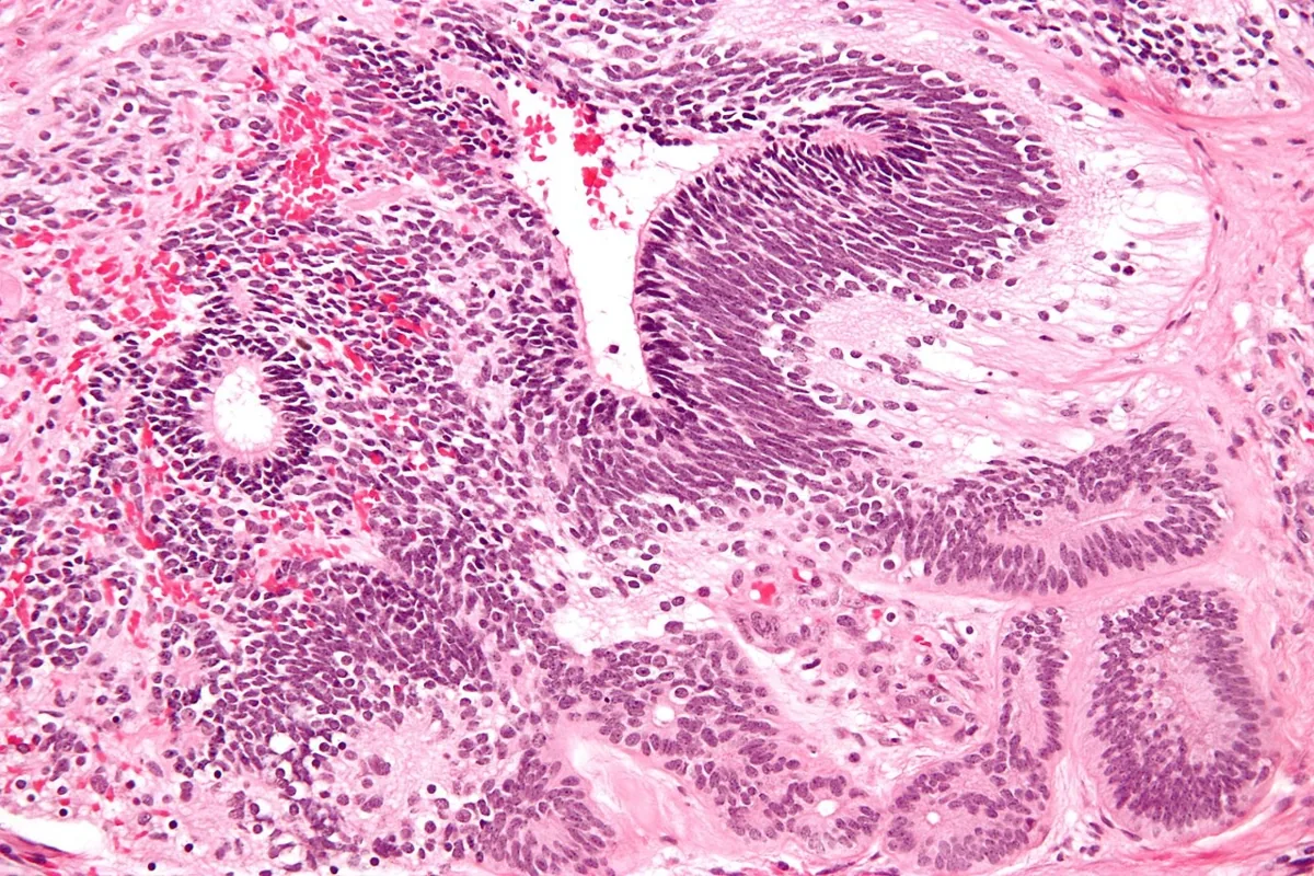 Ovarian germ cell tumours – Histology & cytology: Histology (H&E): immature teratoma – primitive neuroepithelium forming rosettes and tubules (immature neuroectodermal elements determine the grade)