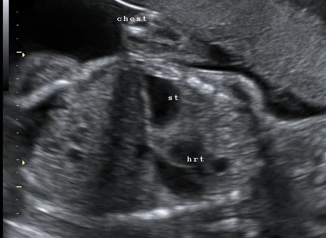 Congenital diaphragmatic hernia – Clinical