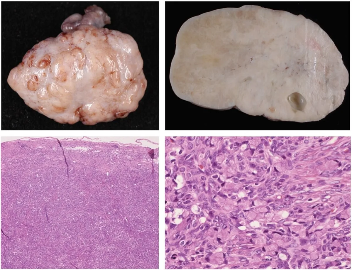Krukenberg tumour – Endoscopy & gross: Gross pathology and histology (H&E): Krukenberg tumour – top: nodular enlarged ovary and whitish solid cut surface; bottom: diffuse infiltration by signet-ring cells in a desmoplastic stroma